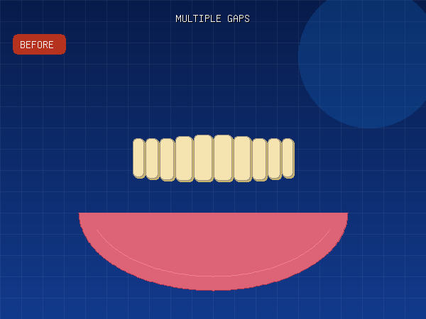 Before — Multiple Gaps & Mild Crowding